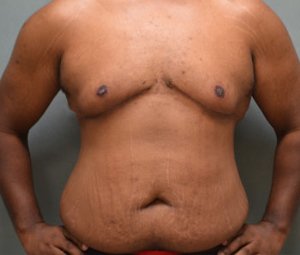 manhattan gynecomastia surgery after 1